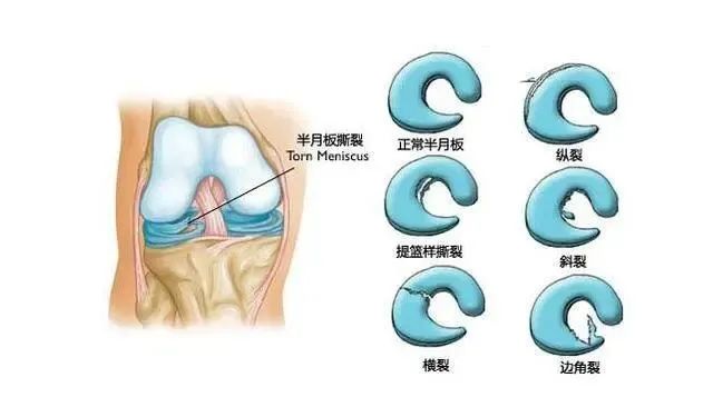 膝盖的“头号杀手”——半月板损伤!(图2)