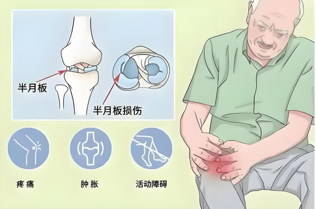 膝盖的“头号杀手”——半月板损伤!(图4)